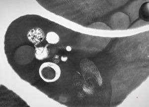 M,49y. | blood - dyserythropoetic anemia